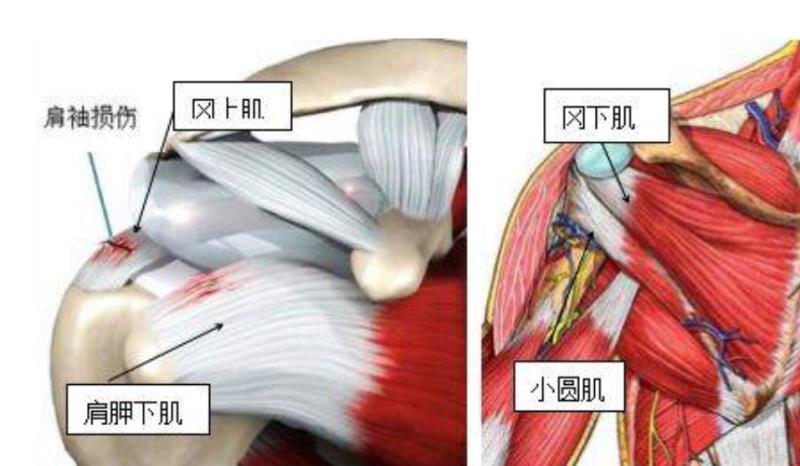 主要特征:1,肩关节痛:肩前方痛,位于三角肌前方及外侧.