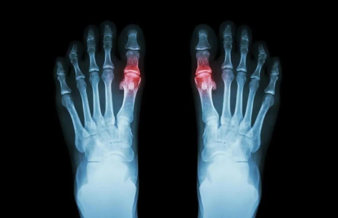 大脚趾,又称"第一跖趾关节",由于这个部位属于躯干核心温度最远的地方