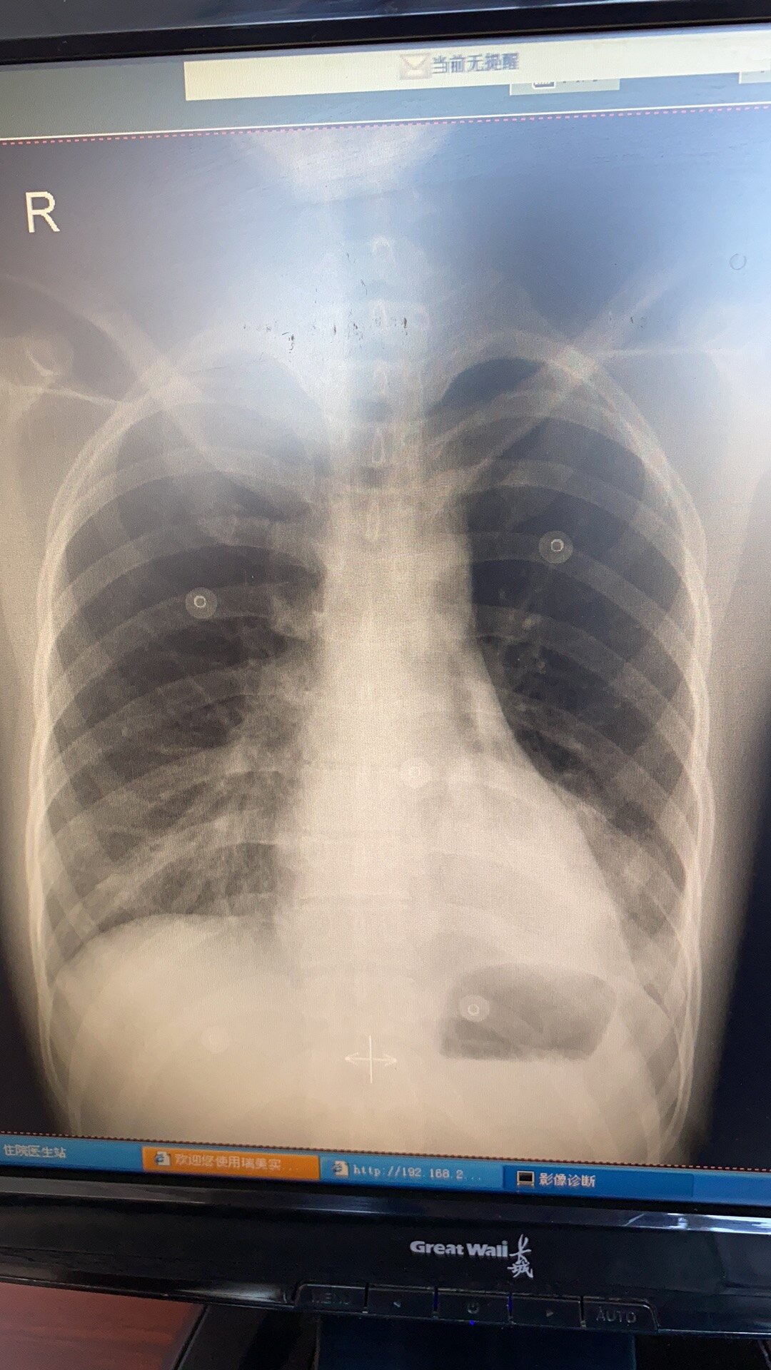 哈医大二院完成一例机器人下左肺s910肺段切除术