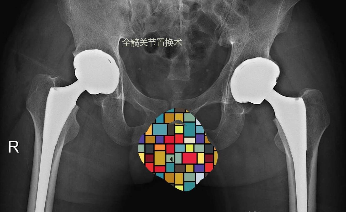 目前全髋关节置换依然是股骨头坏死,髋关节炎等患者治疗的首选术式!4.