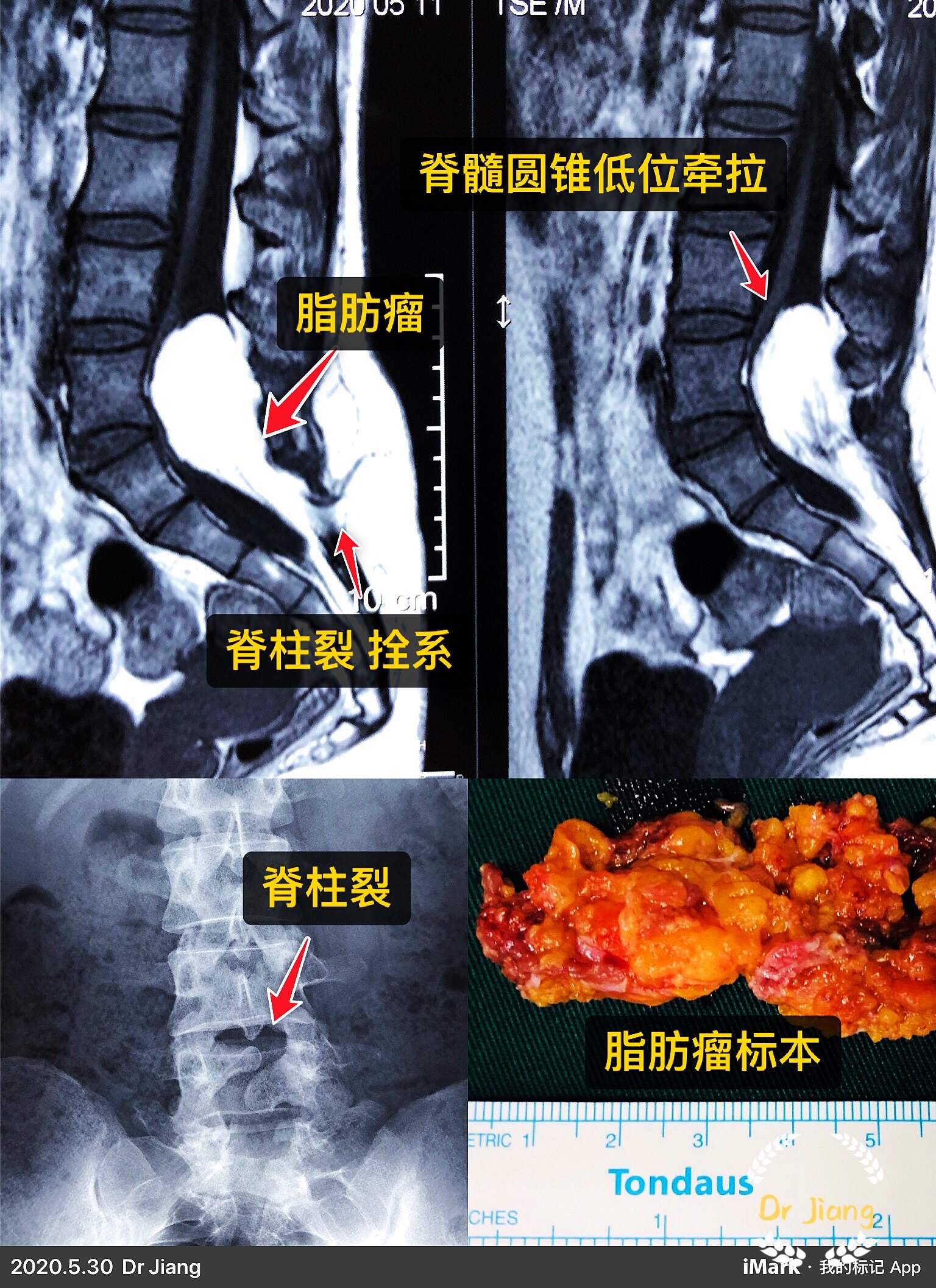 复杂的脂肪瘤型脊髓拴系综合征如何治疗手术病例文献回顾