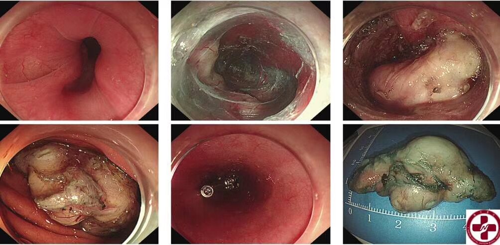内镜下隧道技术食管中段(距离门齿30cm)左侧壁黏膜下肿瘤,大小5*4cm
