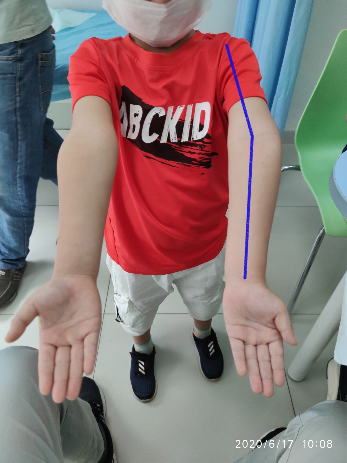 儿童肱骨髁上骨折合并同侧孟氏骨折1例报道 - 标件库