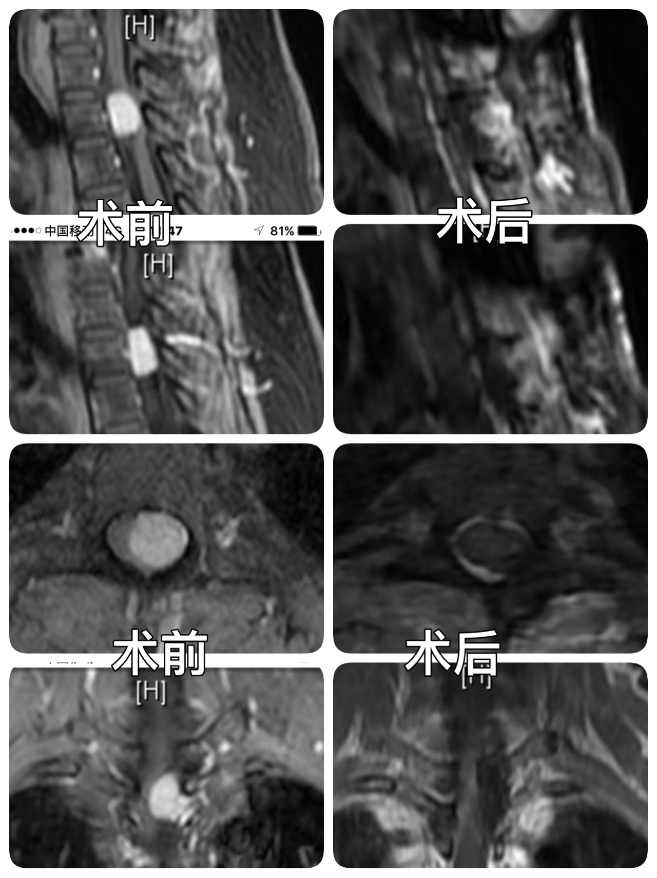 微创切除胸椎脊膜瘤-窦以河-青大附院黄岛院区