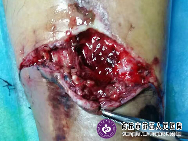 难愈合性创面修复:手术后伤口不愈合典型案例