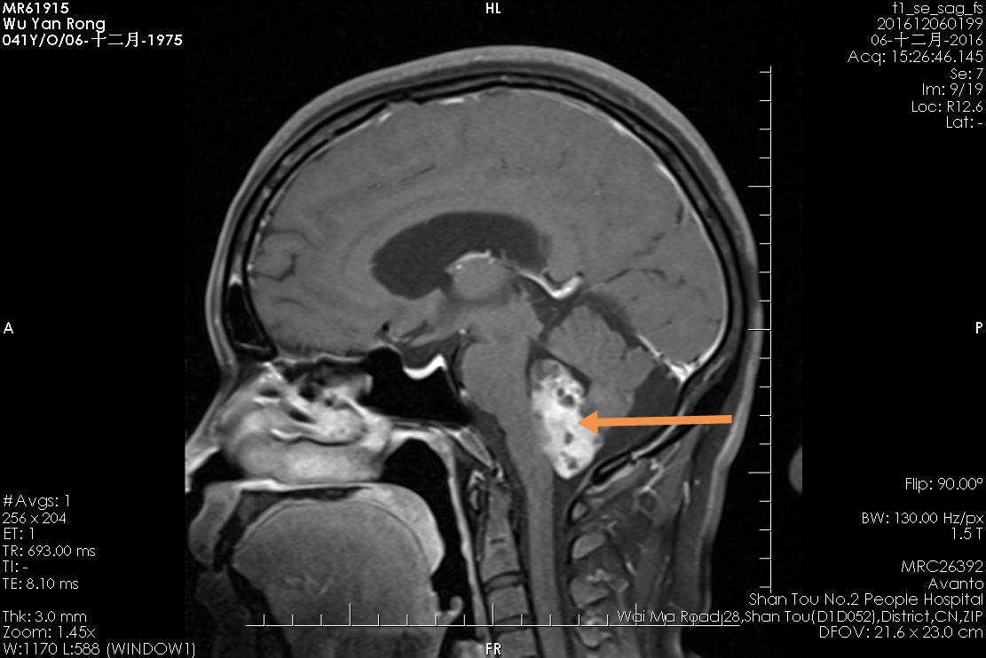 颅脑核磁共振检查结果:第四脑室肿瘤.   检查结果如下图