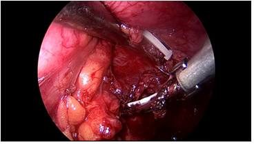 肾盂输尿管连接部梗阻继发肾结石的微创手术治
