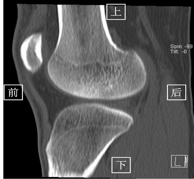 ct (以膝关节为例) 由于ct 是三维成像,包括矢状面,冠状面和横断面三