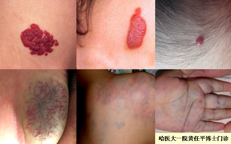 1491295428332071.bmp 血管瘤.bmp