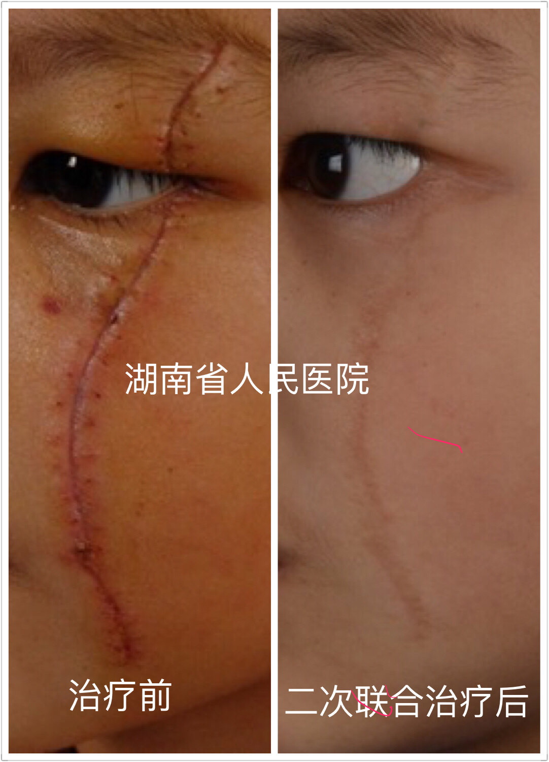 染料激光+点阵激光联合治疗红色增生性瘢痕_