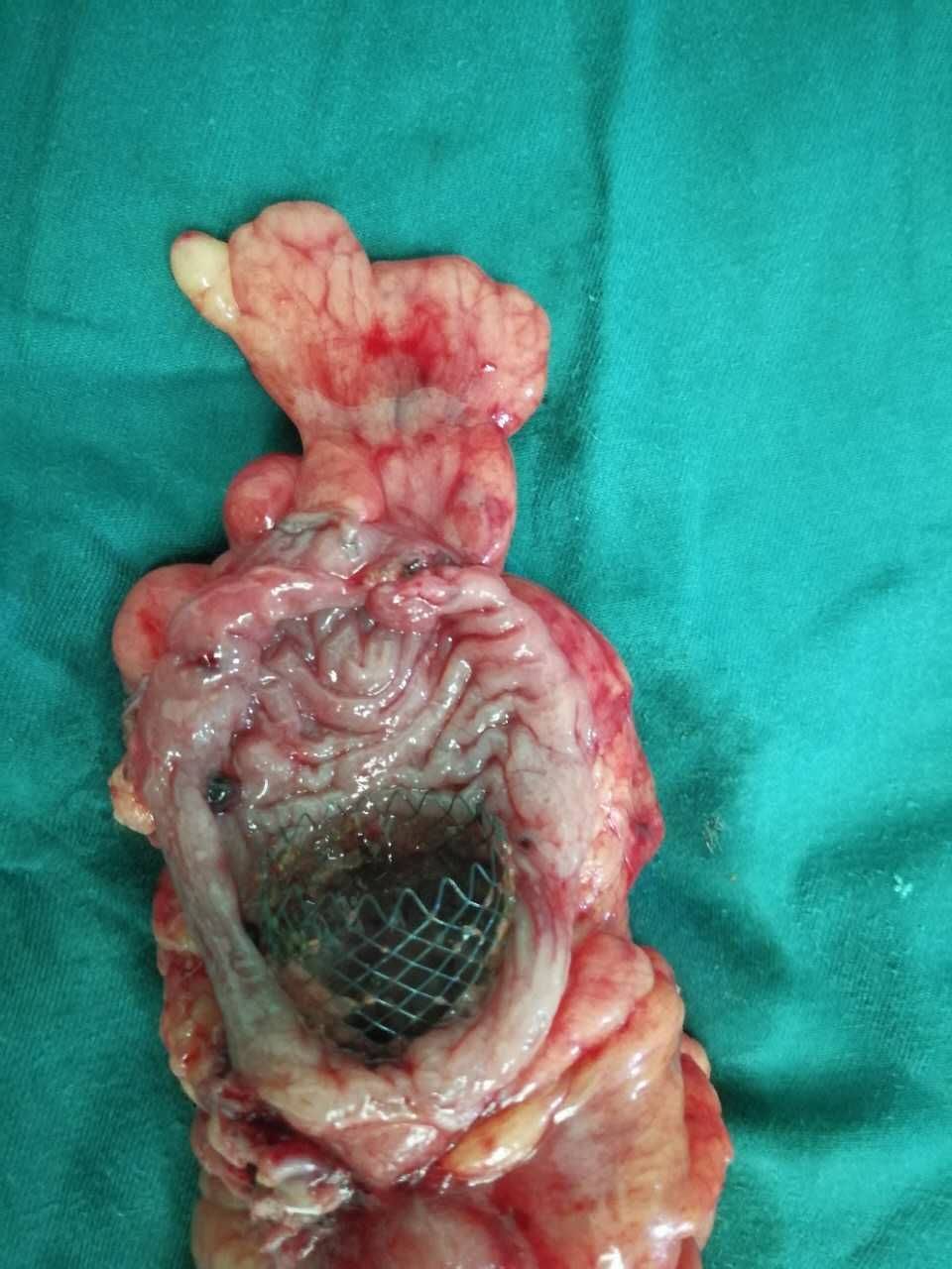 一周后顺利手术,上图为肿瘤切除后看到支架将梗阻肠段完全撑开了肠道