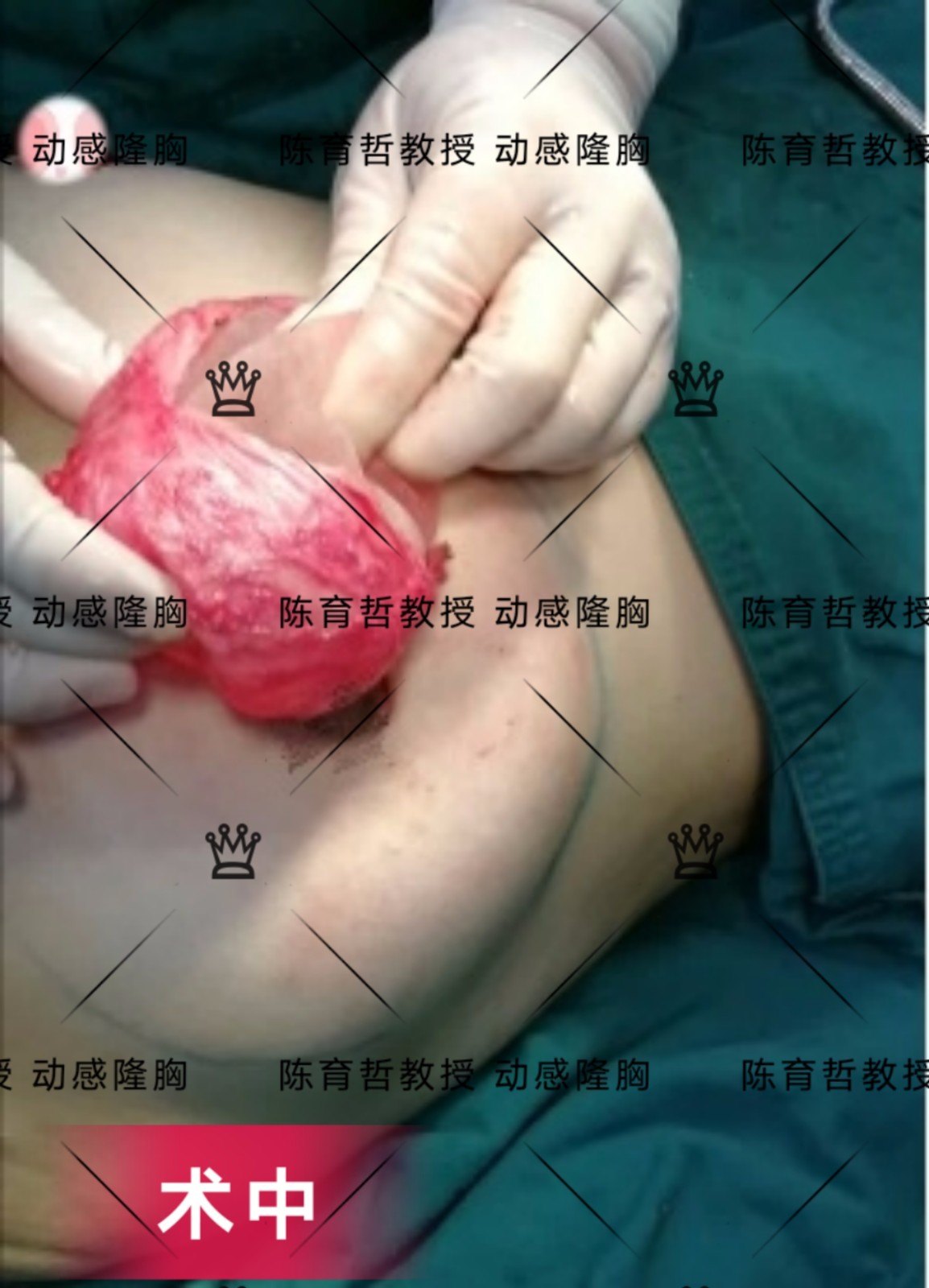 动感隆胸案例(36)注射物取出再植入假体的包膜