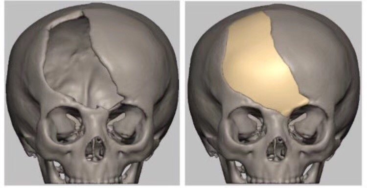 儿童颅骨缺损的手术治疗颅骨修补术