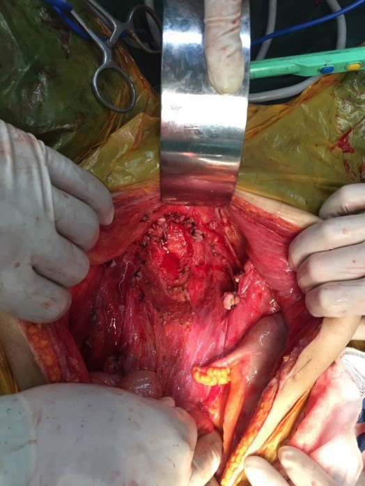 妇科肿瘤腹腔转移:热灌注化疗 手术