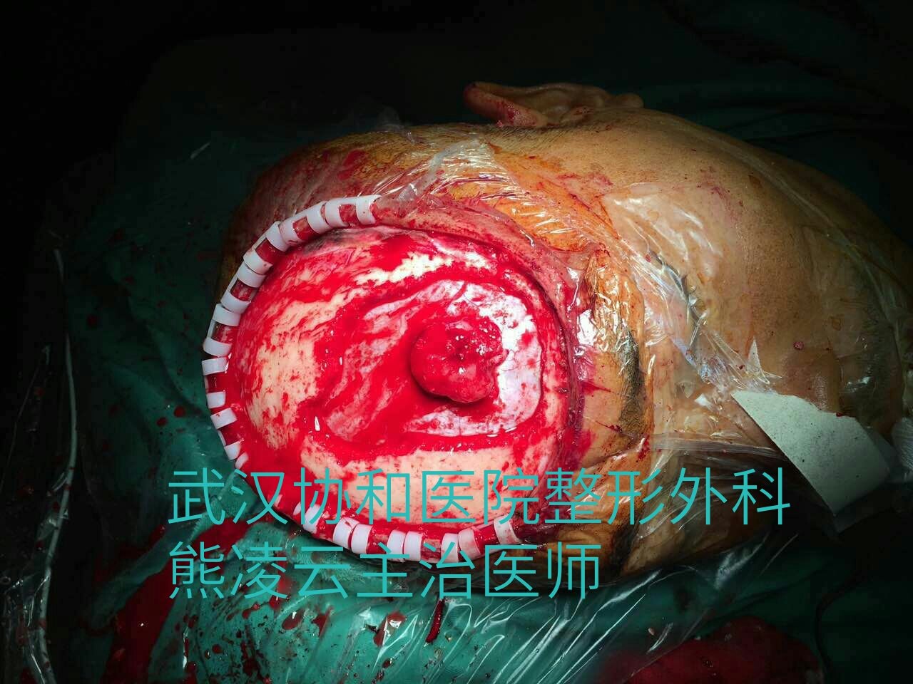 多次复发隆突性皮肤纤维肉瘤的治疗:武汉协和