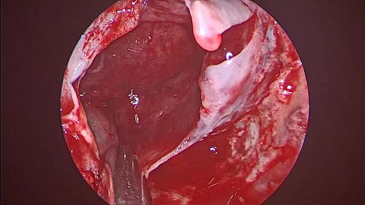 全切一例高泌乳素垂体瘤,内分泌治愈! - 好大夫