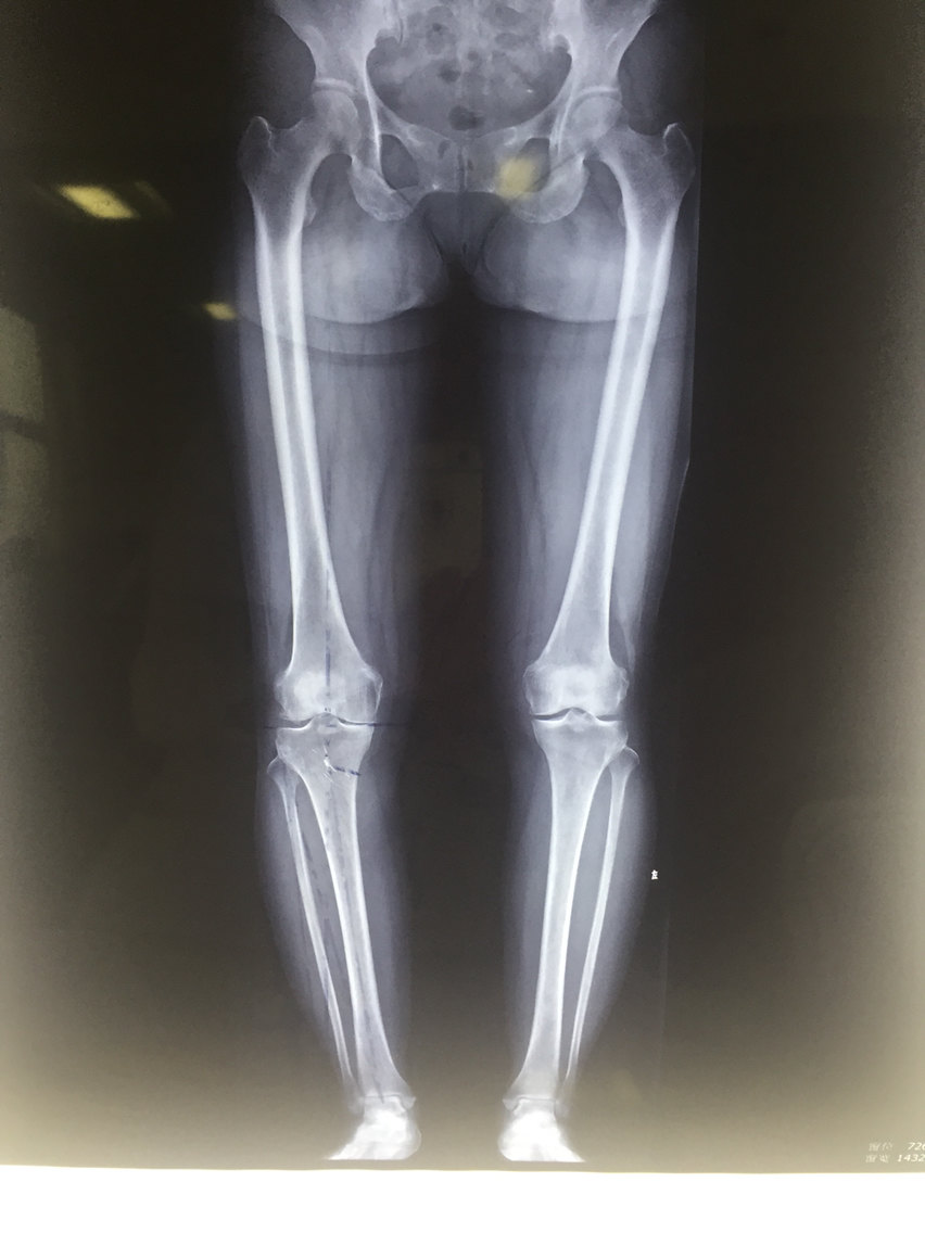 术前x线片,右膝骨关节炎