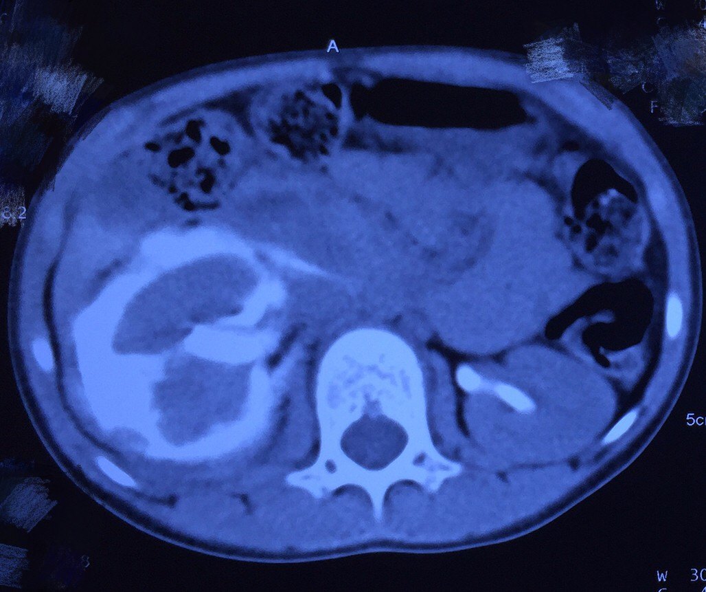 6岁小孩肾外伤后丢失肾脏-家长需要放手不放眼 好大夫在线