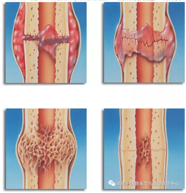 骨折愈合过程