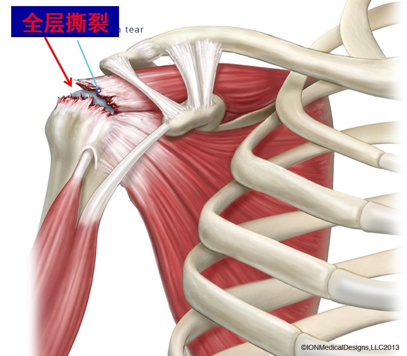 5.全层撕裂.jpg