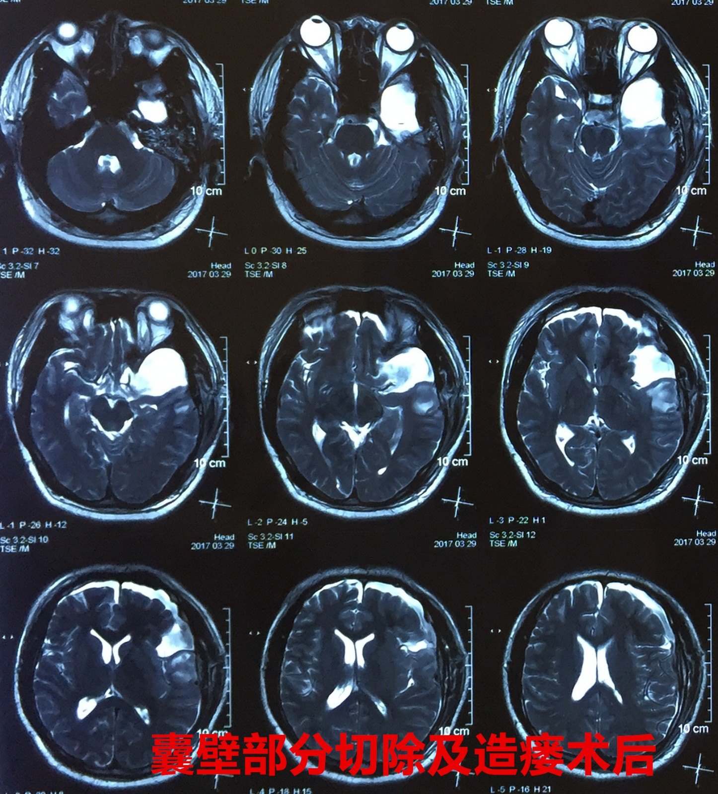 右颞开颅蛛网膜囊肿囊壁部分切除及造瘘术