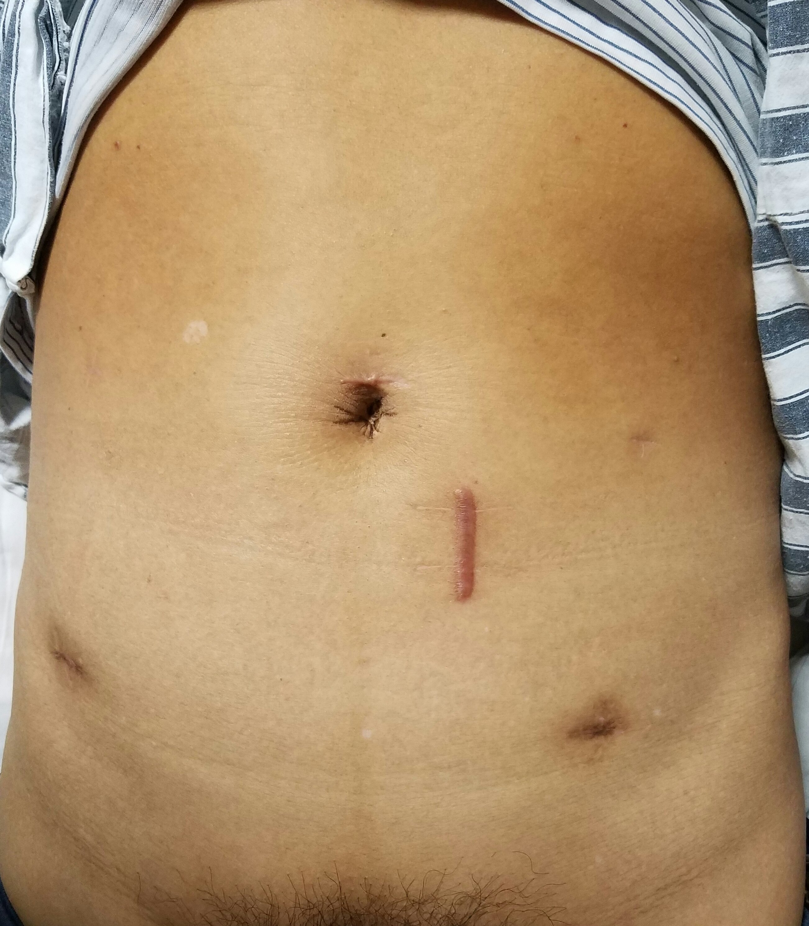 微创手术---有时被误解,常常见效果