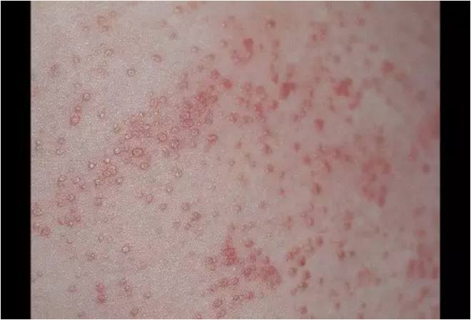 吴蓓玲 文章列表  红色粟粒疹又称红痱.汗液的溢出发生在表皮稍深处.