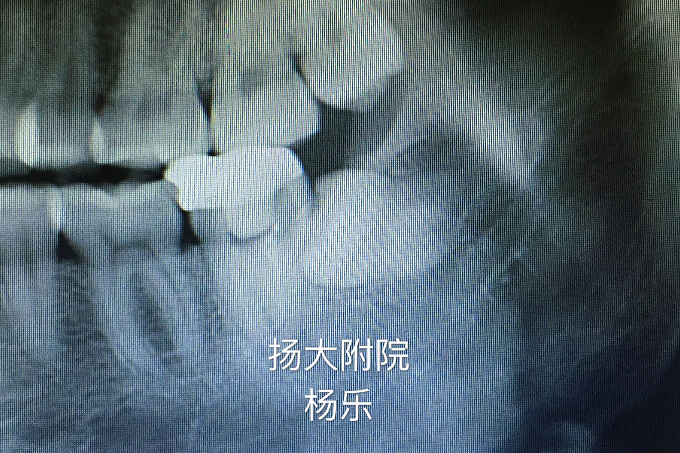 埋伏阻生齿拔除之二