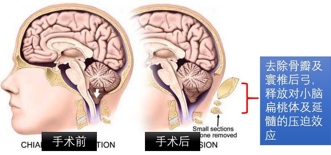 扁桃体下疝的微创手术治疗 凡患者出现梗阻性脑积水或颅内压增高,有