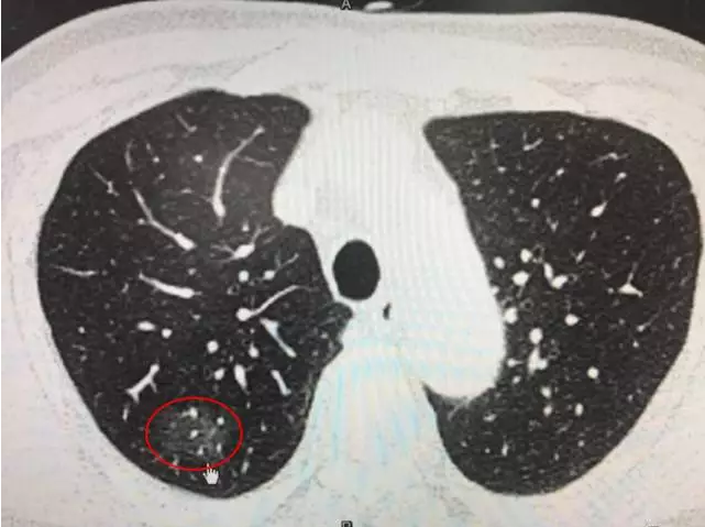 肺磨玻璃结节(GGO)(转发) - 好大夫在线