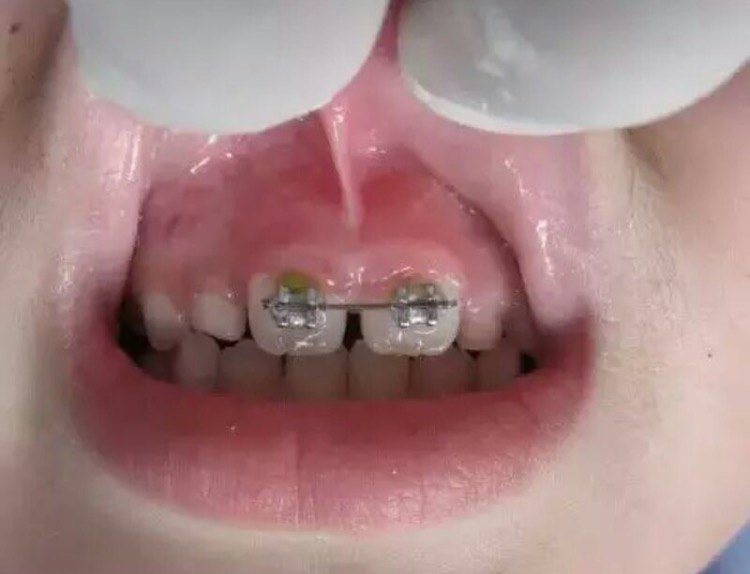 会造成前牙咬不拢,儿童上下门牙前突等畸形,严重者可能影响到上下骨