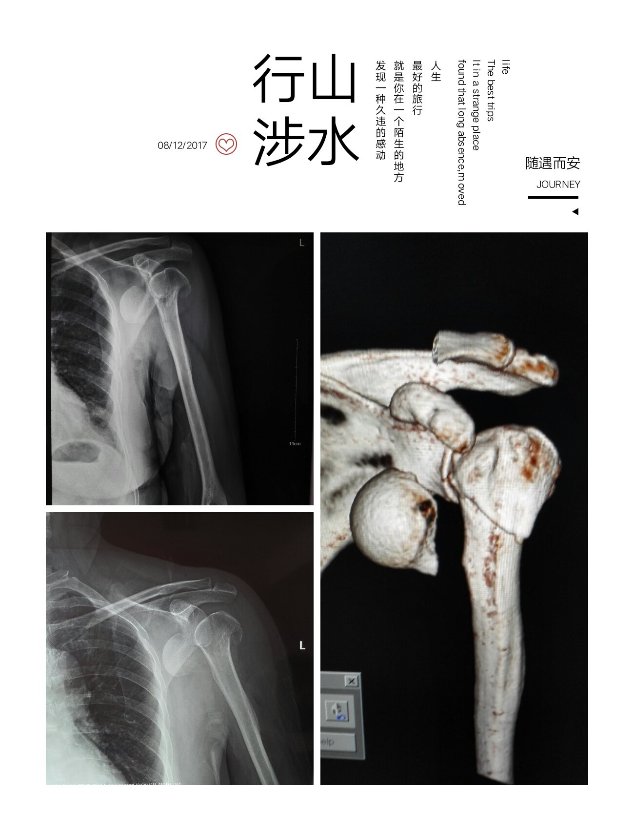 肱骨近端骨折伴有头脱位