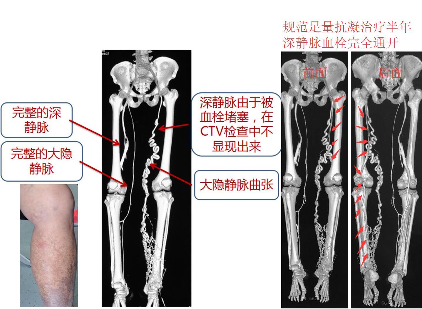 1513220714992491.jpg PTS DVT.jpg