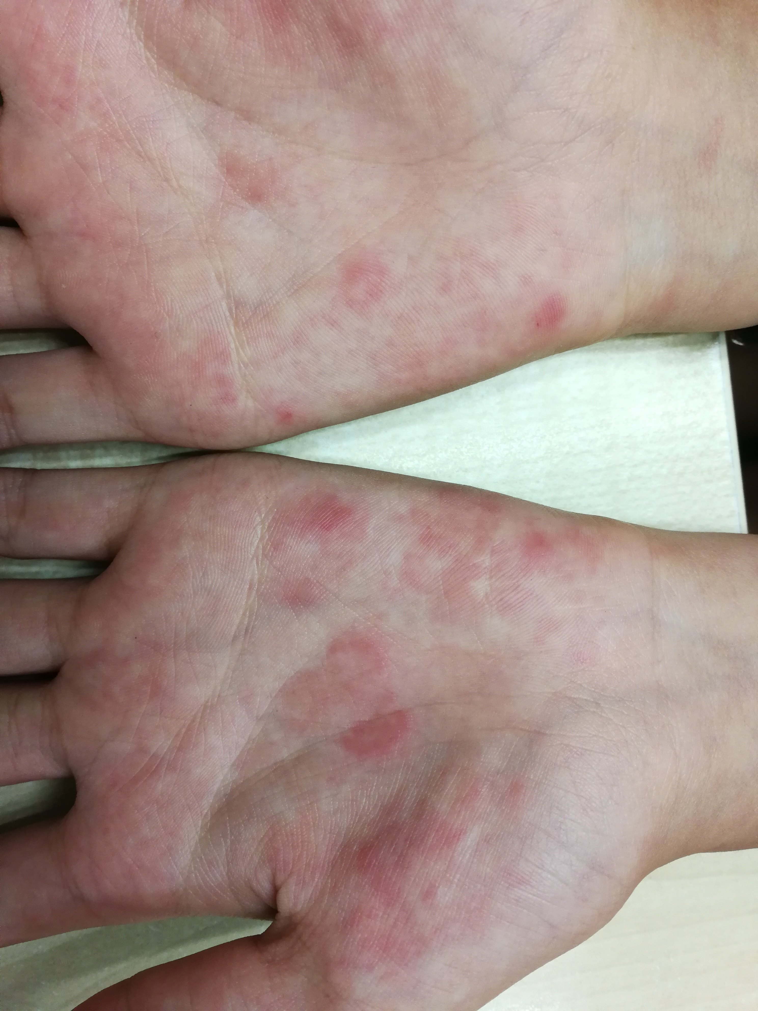 红斑狼疮皮疹表现展示 (原创)