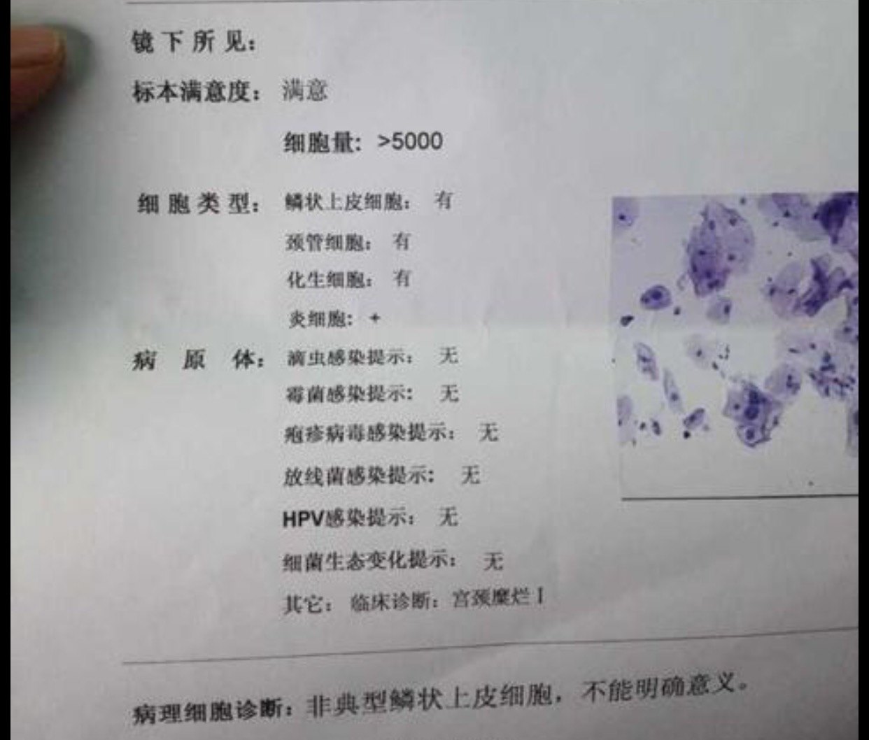 如何快速解读tct报告 - 好大夫在线