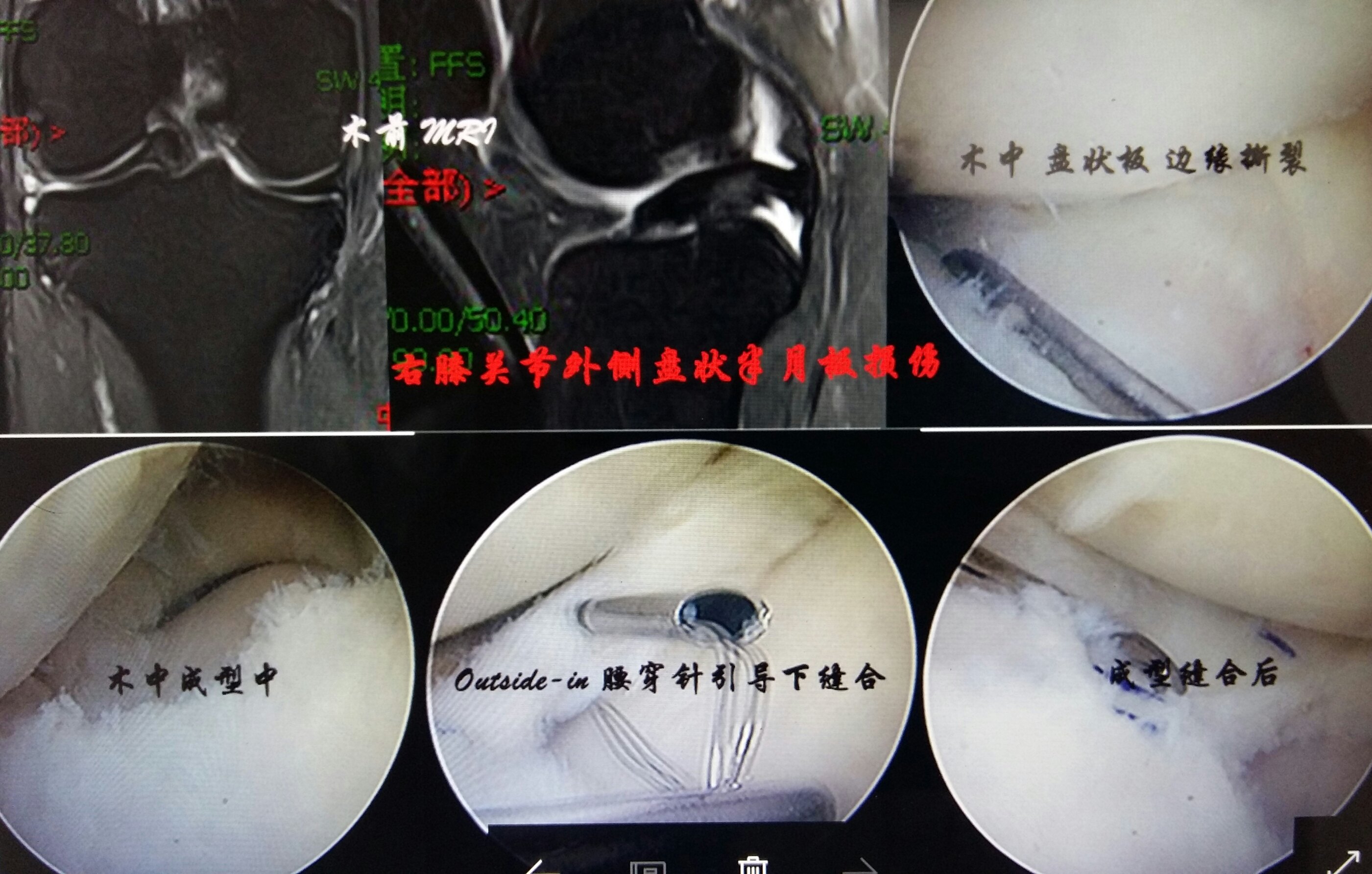 盘状半月板陈旧性损伤仍可关节镜下成型缝合