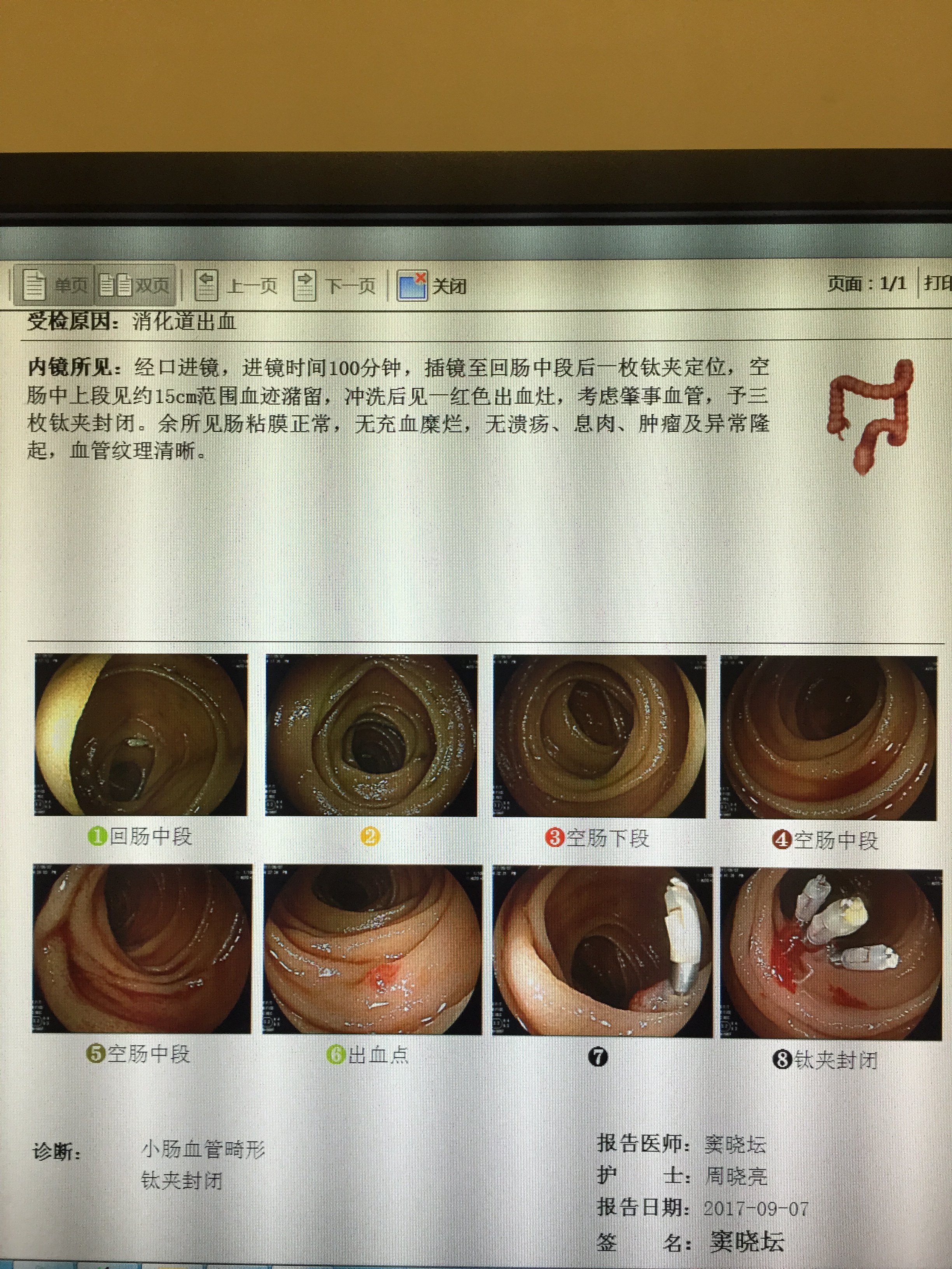 小肠血管畸形