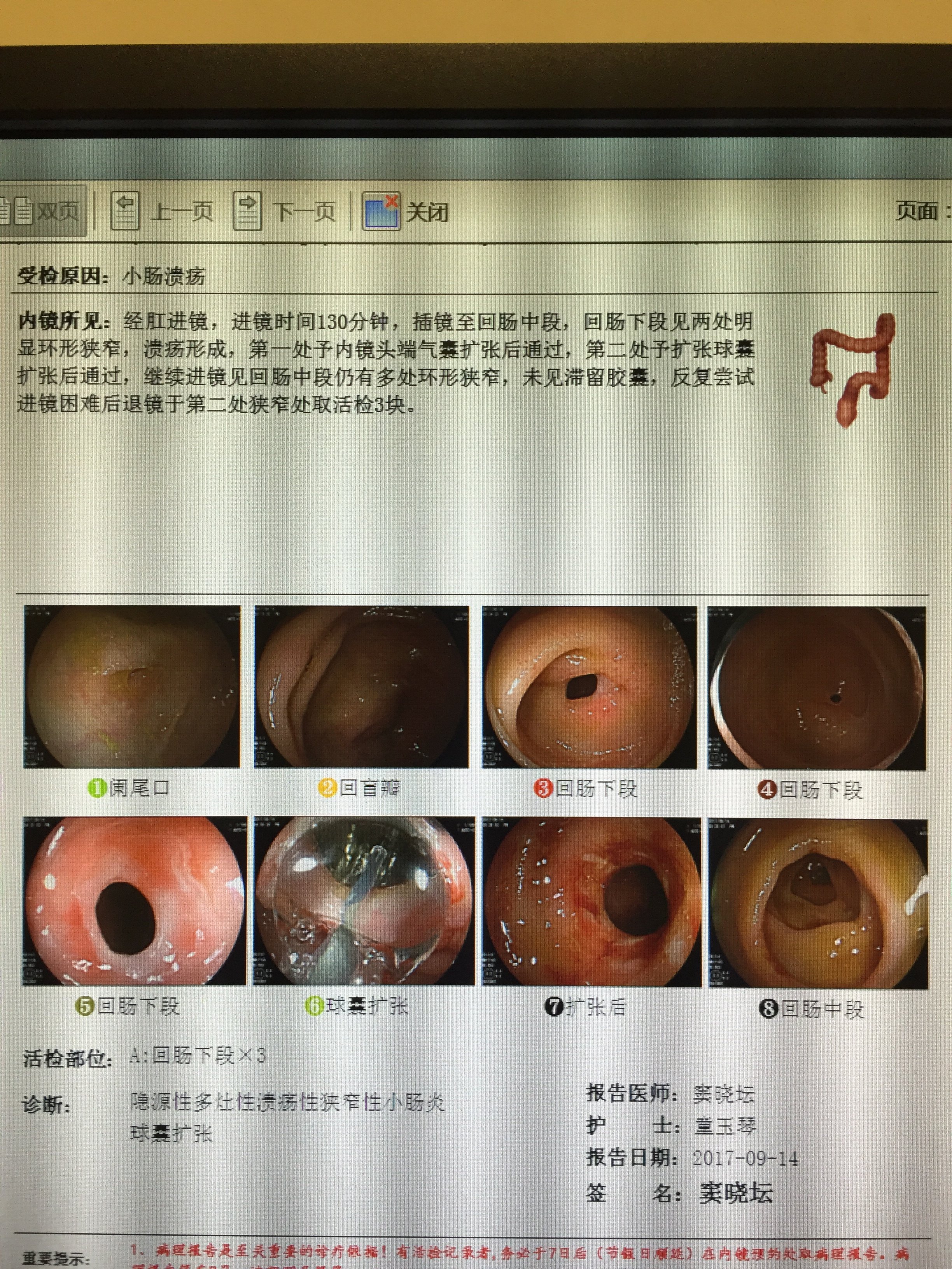 诊断隐源性多灶性溃疡性狭窄性小肠炎一例