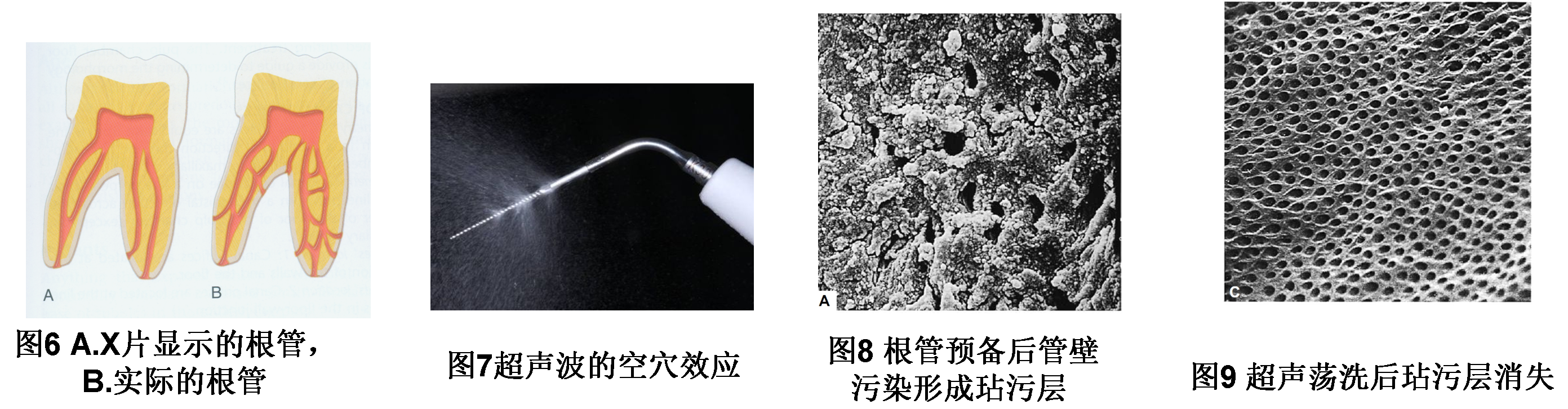 根管治疗科普问答4超声清洗根管更干净