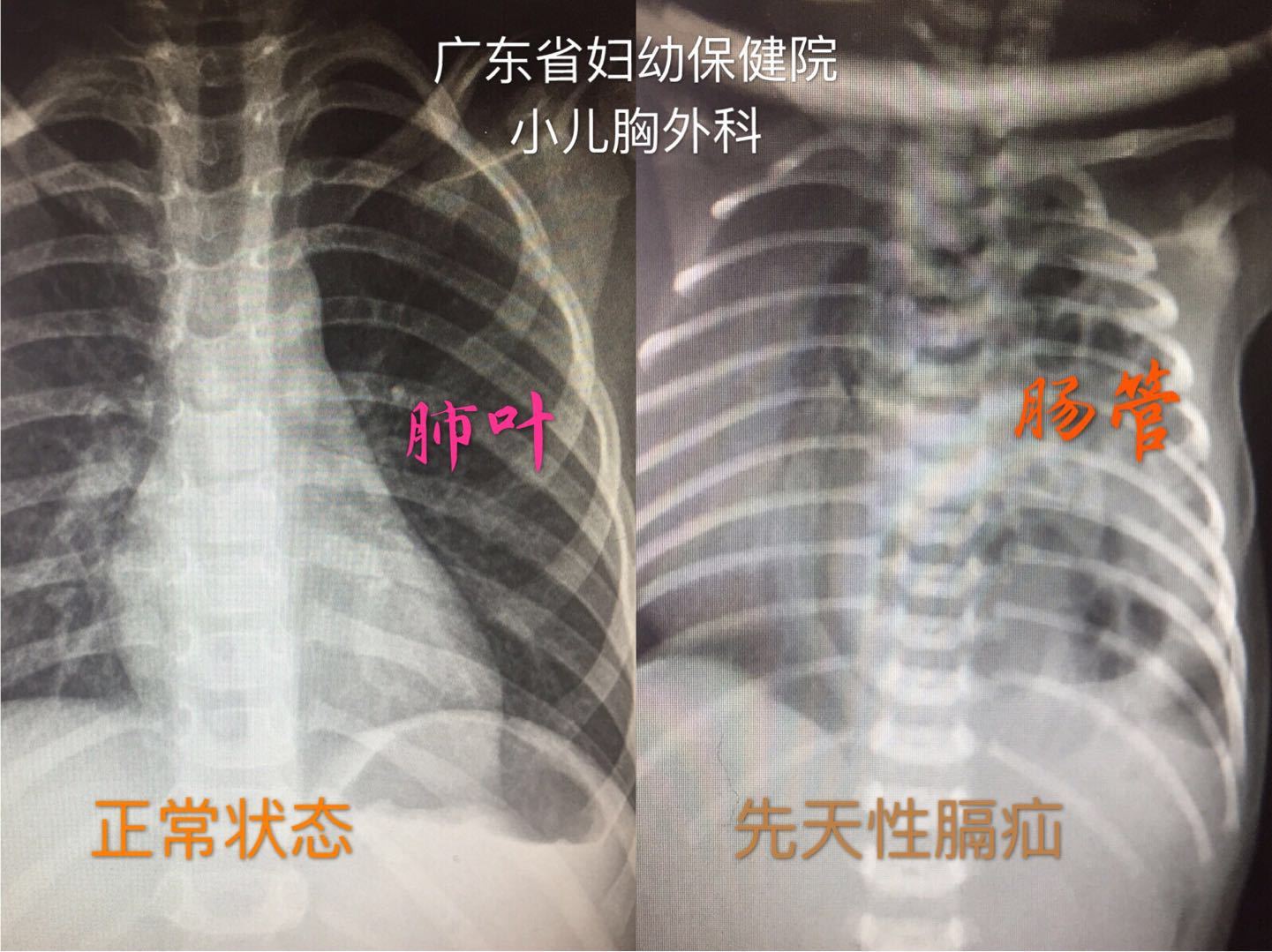 先天性膈疝有多少概率