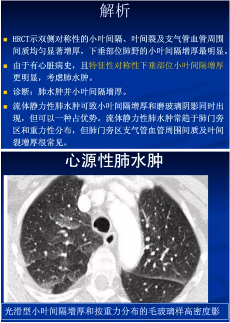 不同类型肺水肿的ct表现