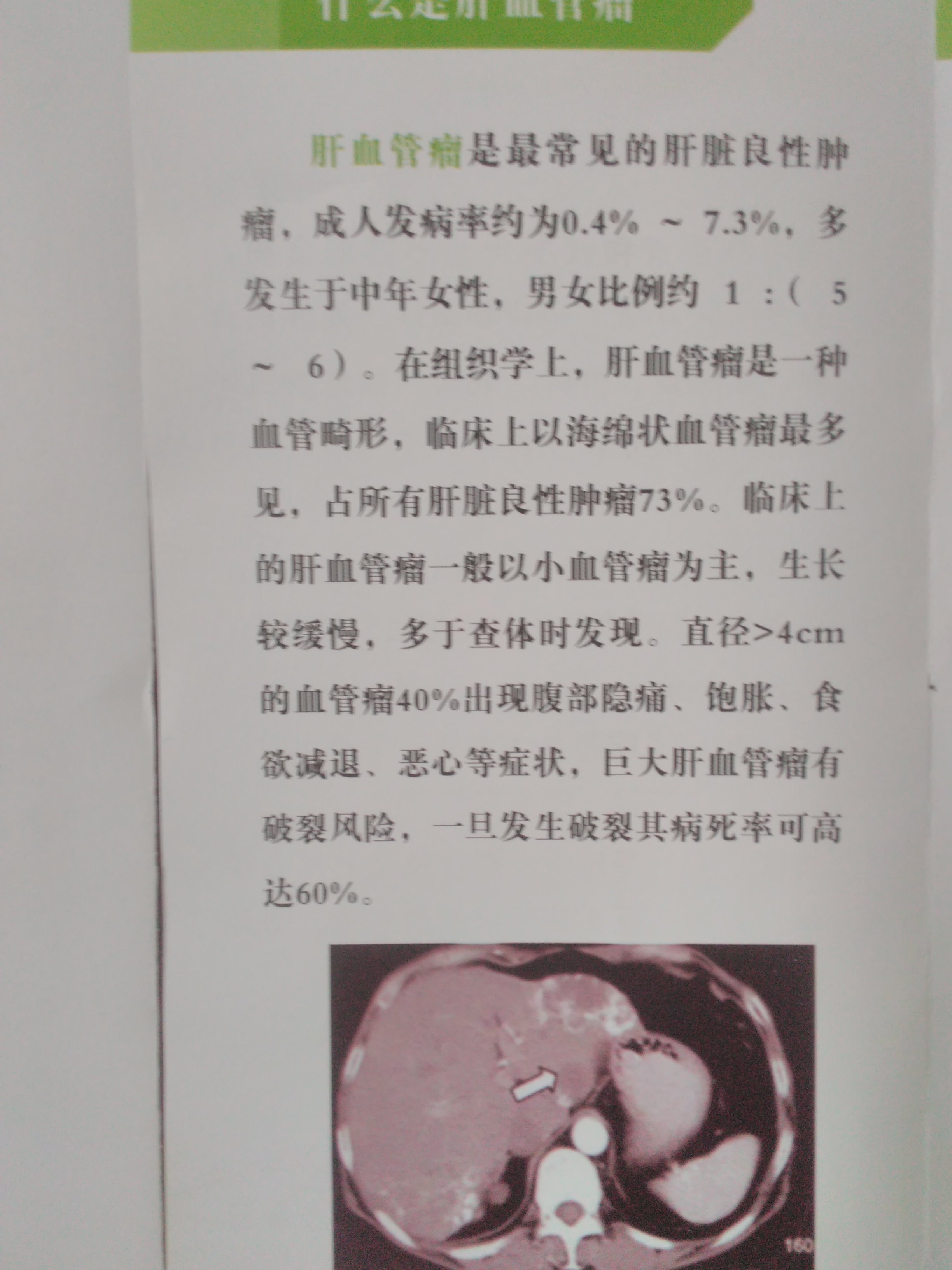 肝血管瘤介入微创治疗