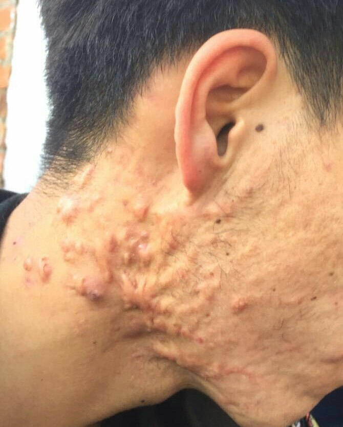 面部痤疮及痤疮导致的面部瘢痕疙瘩的核医学治