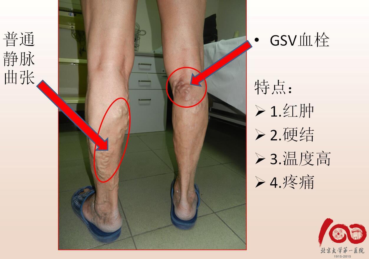 1511362234925542.jpg 血栓性静脉炎图.jpg