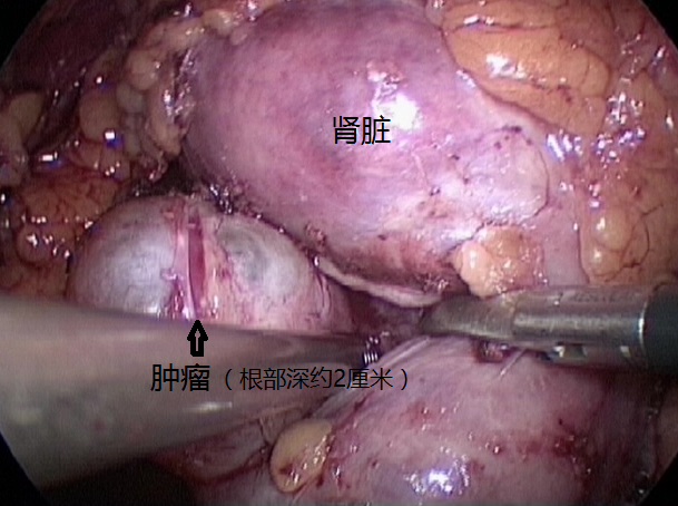 腹腔镜肾部分切除术治疗肾肿瘤1