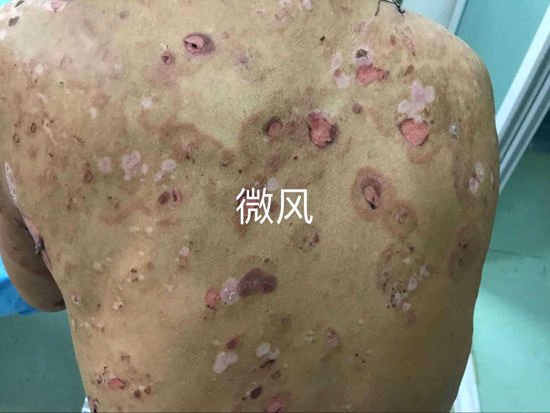不用激素治疗疱病