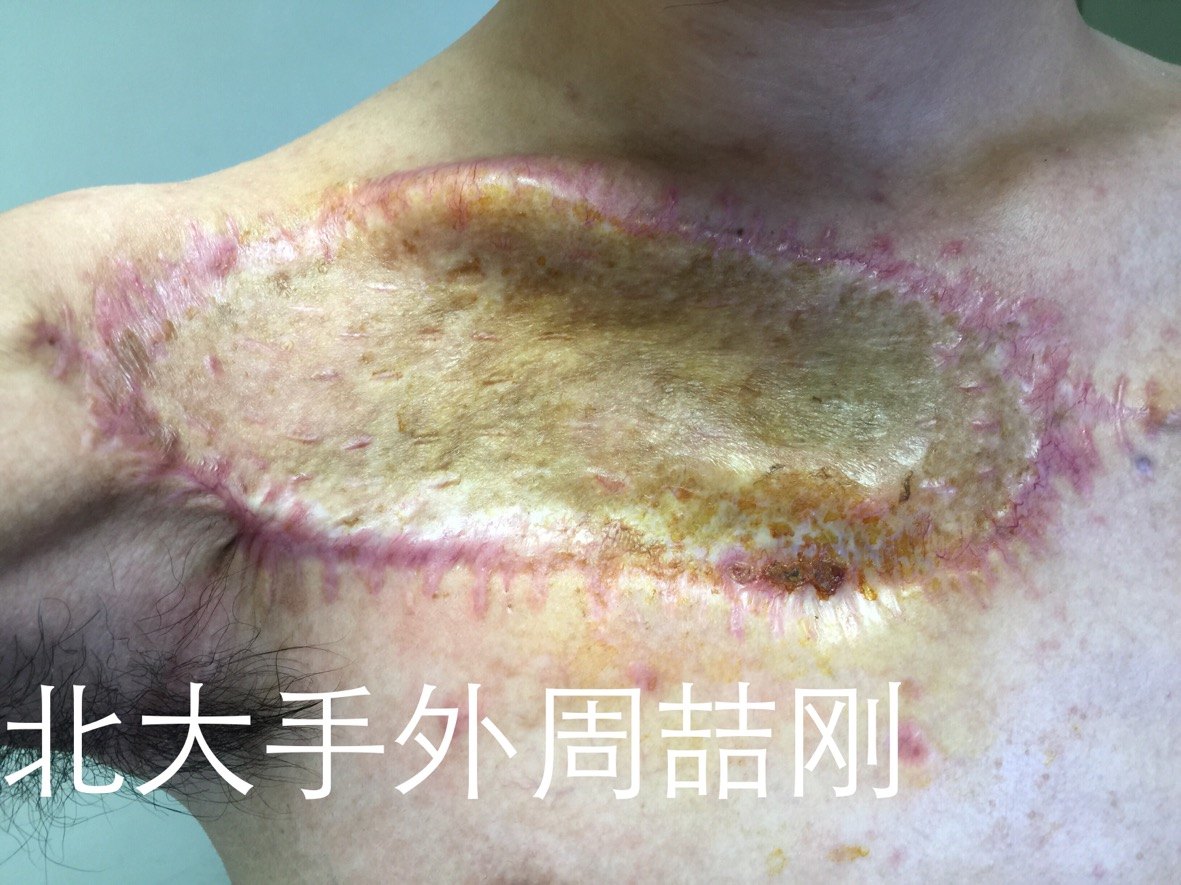 胸壁巨大隆突性皮肤纤维肉瘤的根治性切除