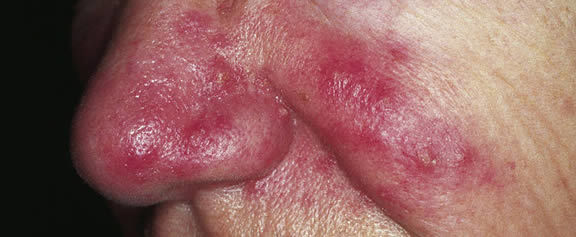 Acne-Rosacea.jpg