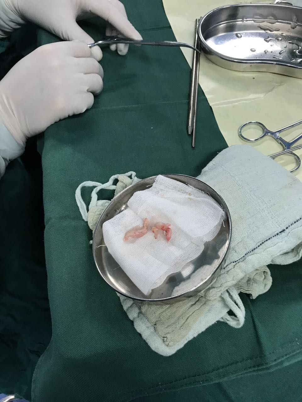 椎间孔镜微创治疗腰椎间盘突出症 - 好大夫在线