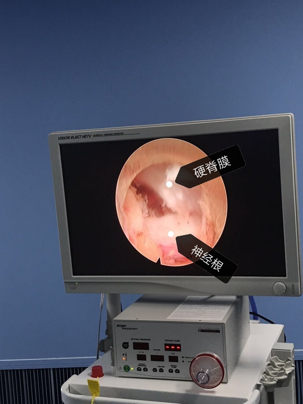 椎间孔镜微创治疗腰椎间盘突出症 - 好大夫在线